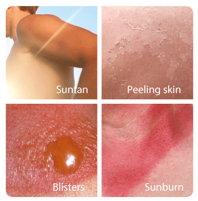 UV-stråling og UV-lys – slik påvirkes huden